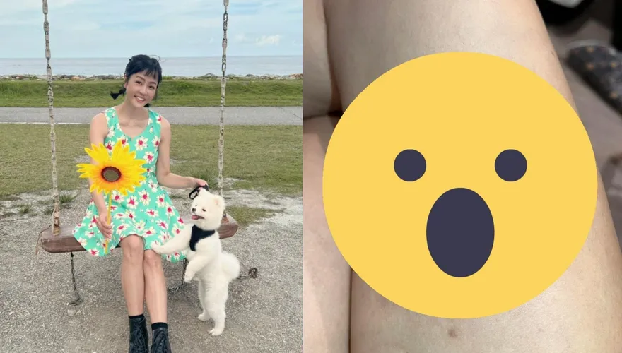 癌末「摘卵巢、子宮」續命！唐玲大腿「突遍佈紅斑、血痕」網嚇壞　無奈揭近況